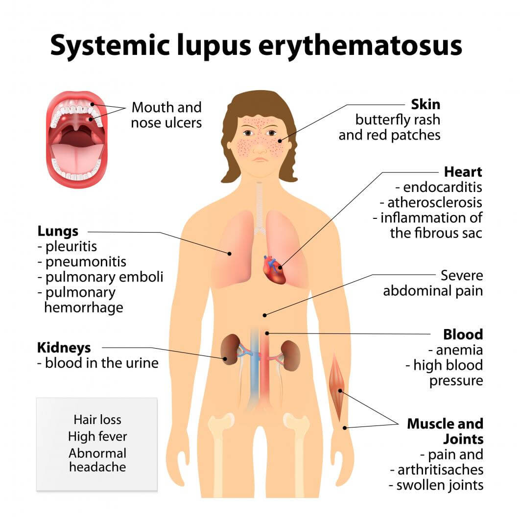 Lupus Symptoms In Women Causes Diagnosis And Treatment 6568