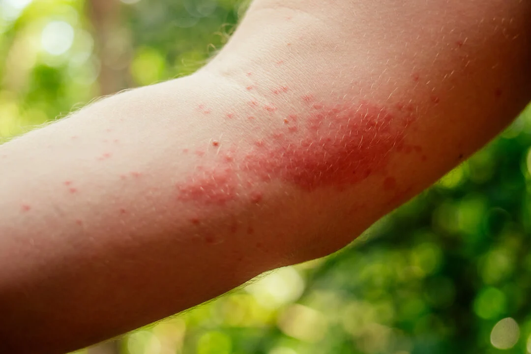 stinging nettle rash spreading